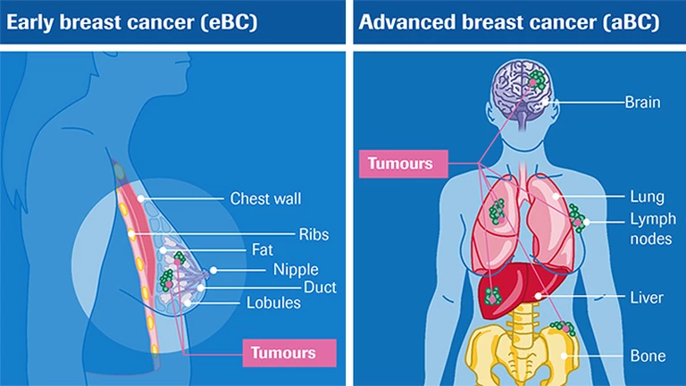 Breast Cancer staging